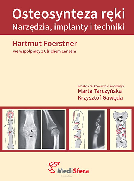 Osteosynteza ręki. Narzędzia, implanty i techniki